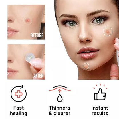 Chin Acne Day & Night Repair Patch